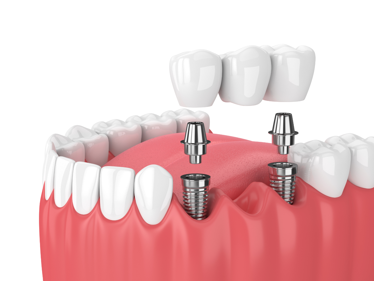 Managing Common Misconceptions and Fears Regarding Dental Implants